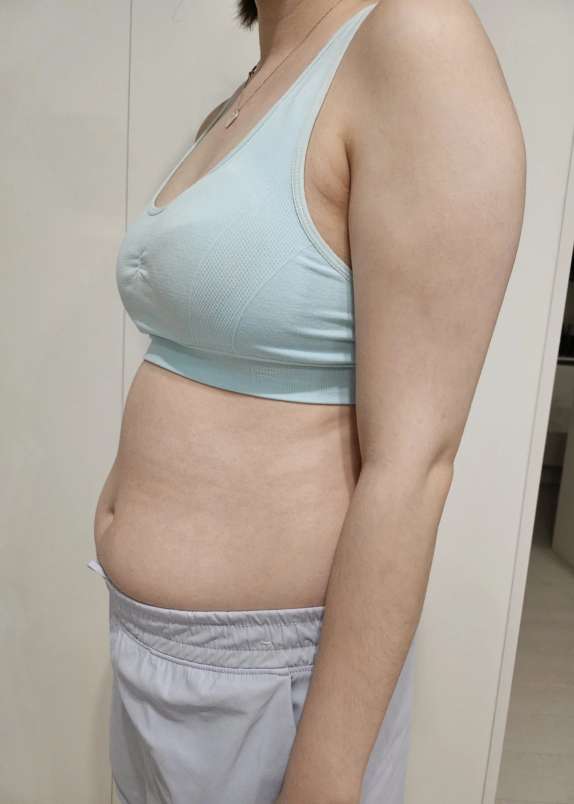 It's been 6 months since my abdomen, lov - Arm Liposuction Before 2 - TheLINE Plastic Surgery