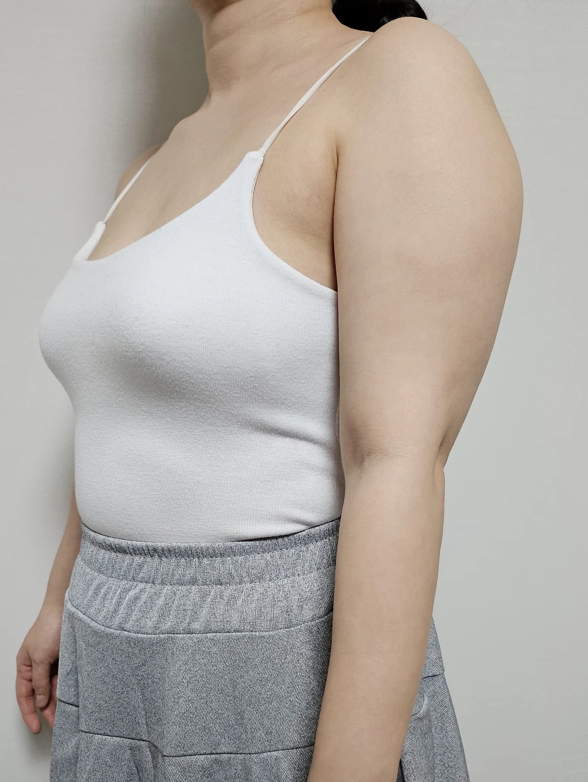 This is my 6-month upper arm lipo review - Arm Liposuction Before 2 - TheLINE Plastic Surgery
