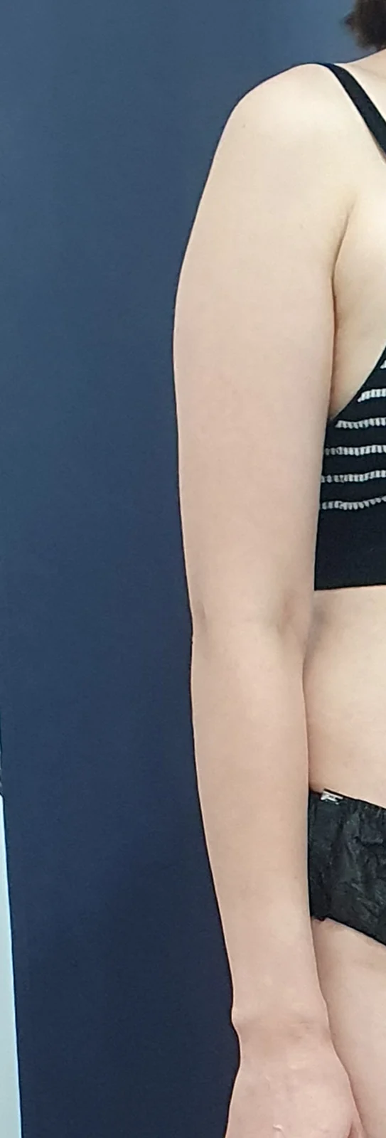 Liposuction highly recommended haha - Arm Liposuction Before 2 - TheLINE Plastic Surgery