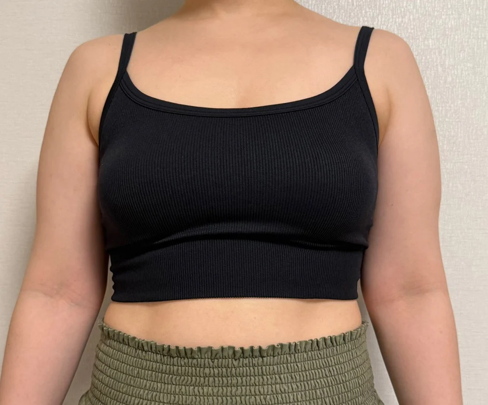 Six-month arm liposuction review - Arm Liposuction Before 2 - TheLINE Plastic Surgery