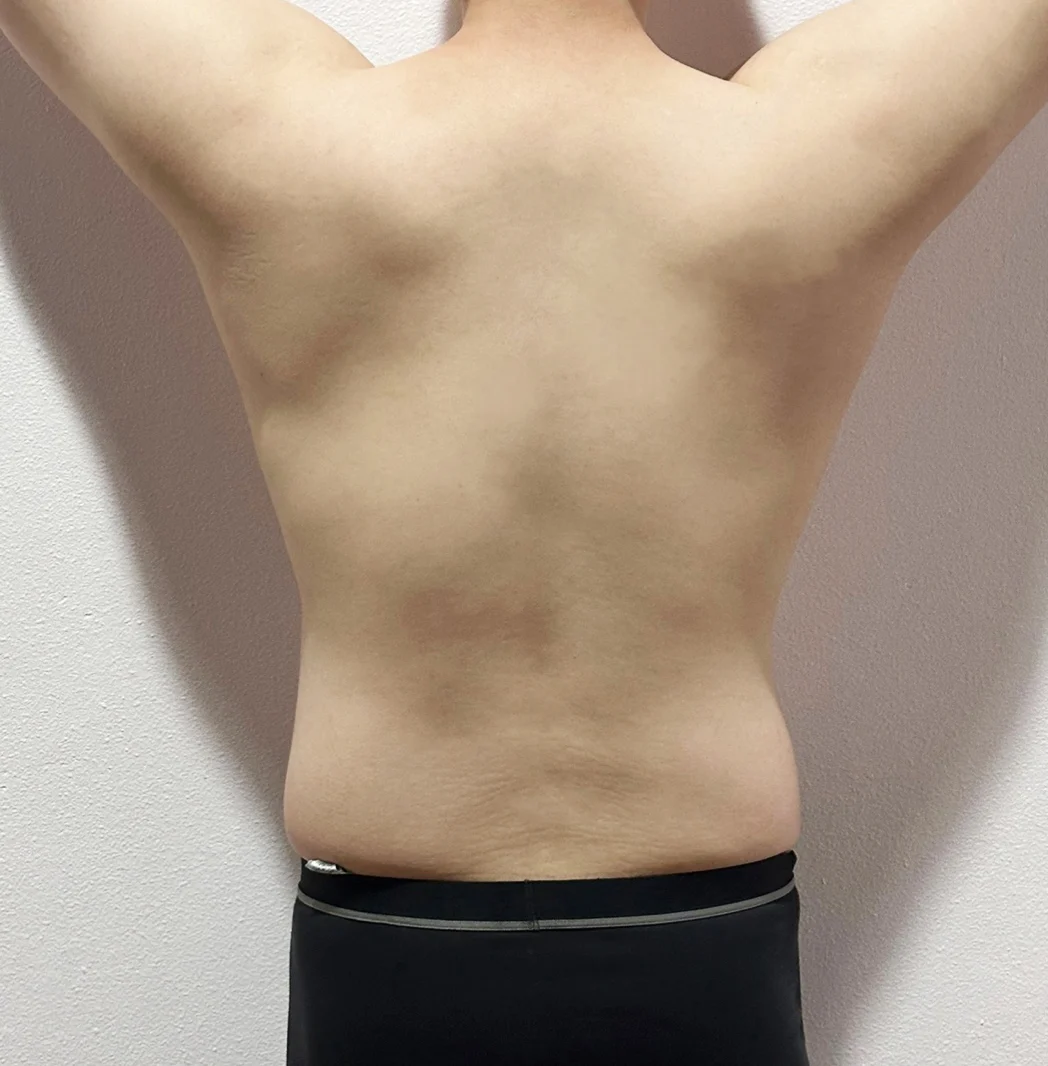 Three months after abdomen, love handles - Abdominal Liposuction (Upper Body) Before 2 - TheLINE Plastic Surgery