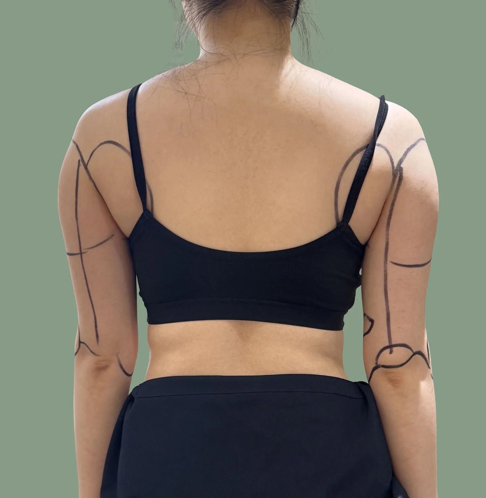 One month after upper arm lipo!!!! - Arm Liposuction Before 2 - TheLINE Plastic Surgery