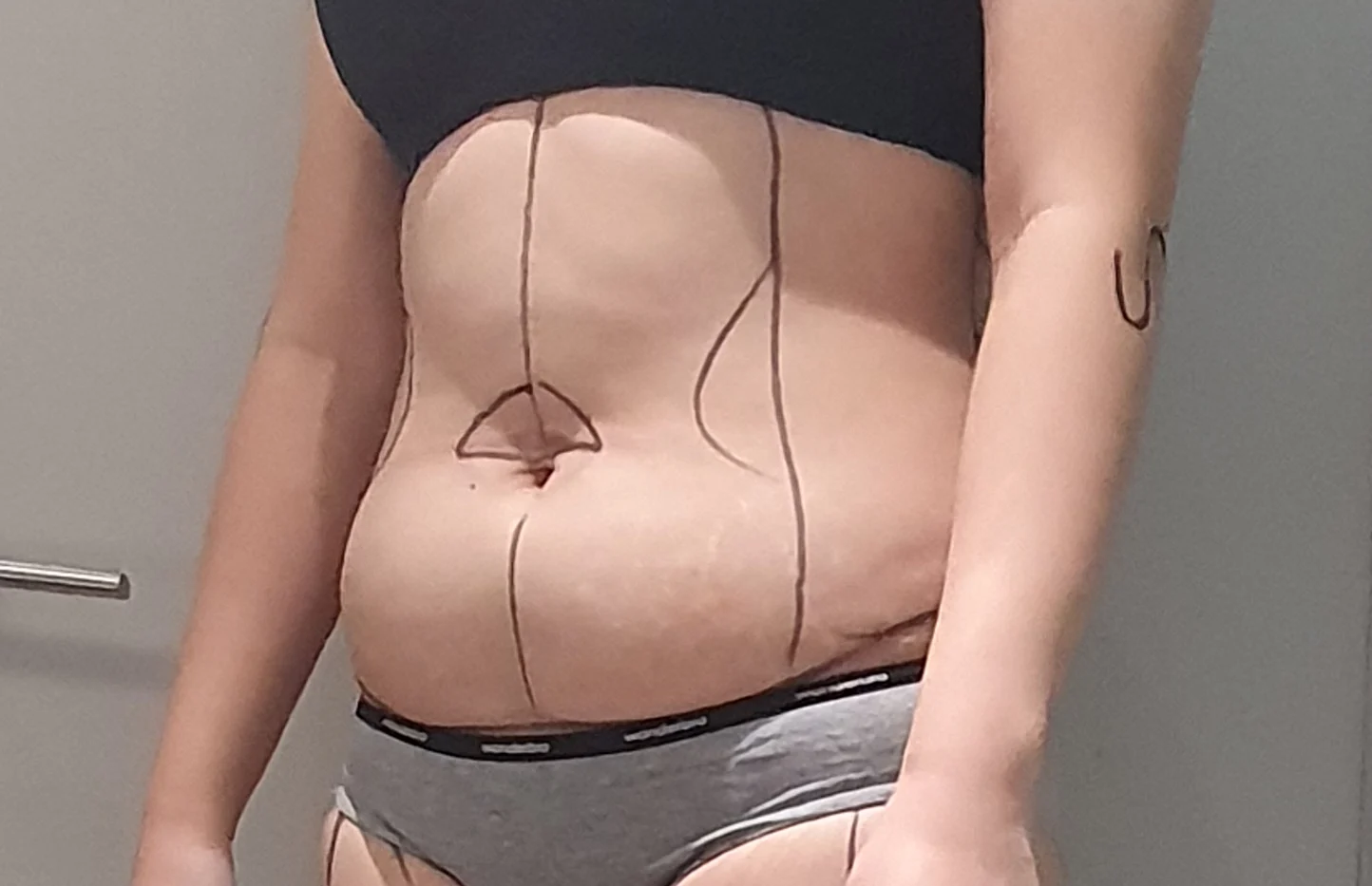 Get liposuction and see the light haha - Other Liposuction Before 2 - TheLINE Plastic Surgery