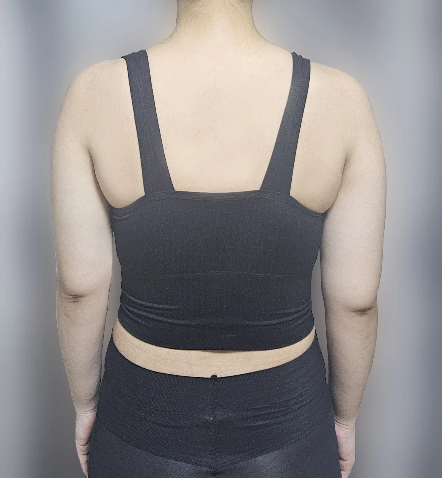 It's been a month since my arm lipo - Arm Liposuction Before 2 - TheLINE Plastic Surgery