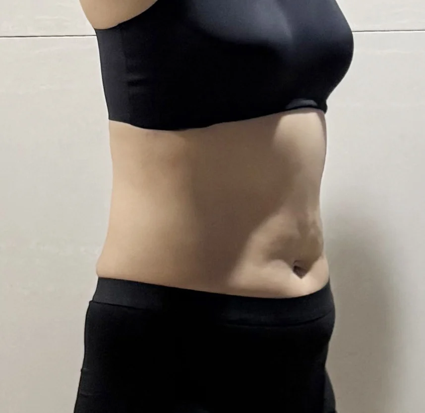 This is my one-month review - Abdominal Liposuction (Upper Body) Before 2 - TheLINE Plastic Surgery