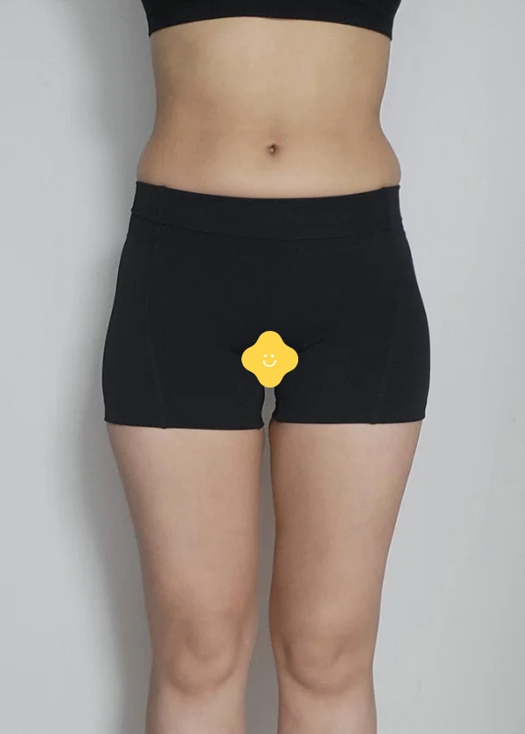 Three months after abdomen, thighs and h - Hip Fat Grafting Before 2 - TheLINE Plastic Surgery