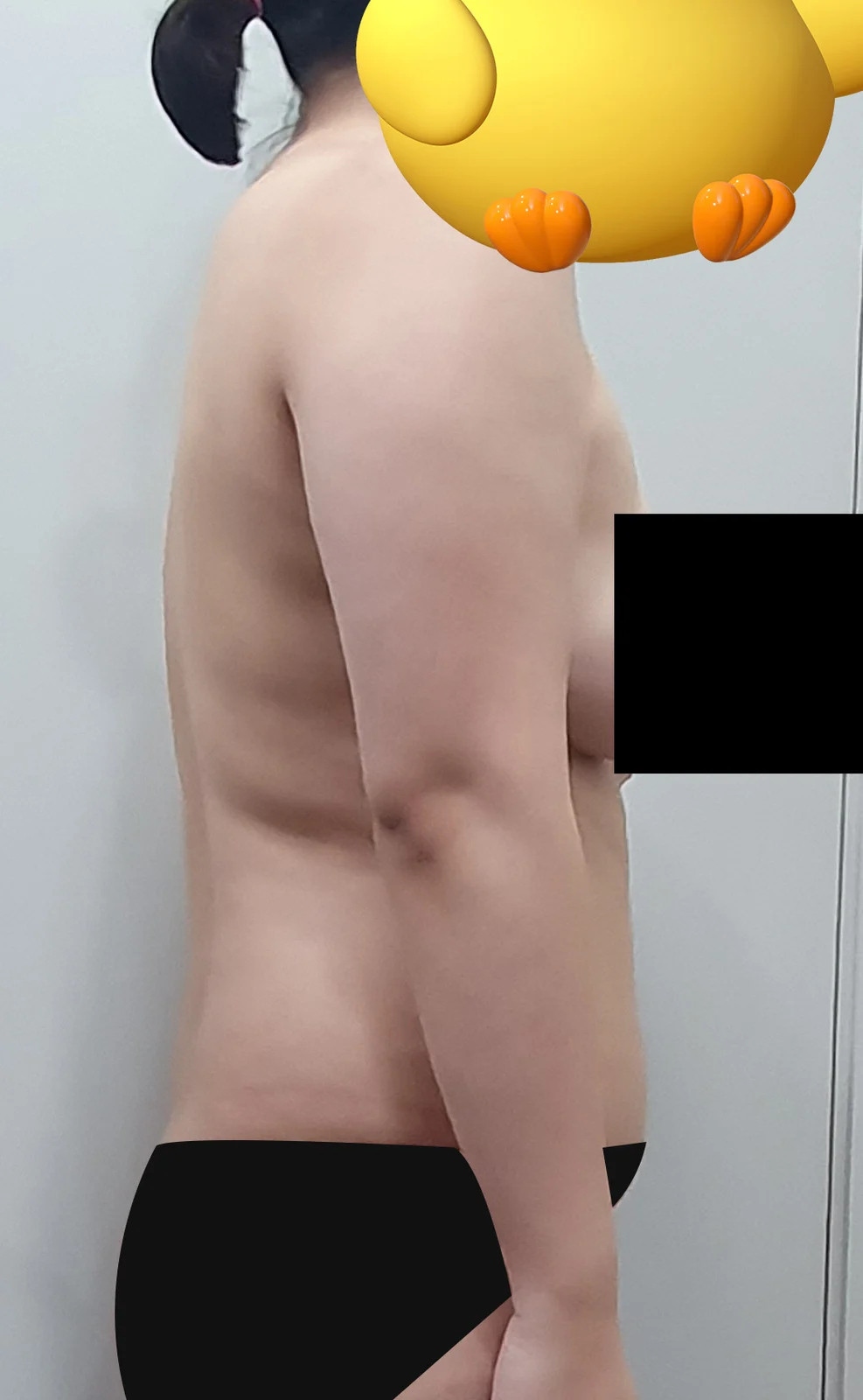 I'm three months post-liposuction!! - Arm Liposuction Before 2 - TheLINE Plastic Surgery