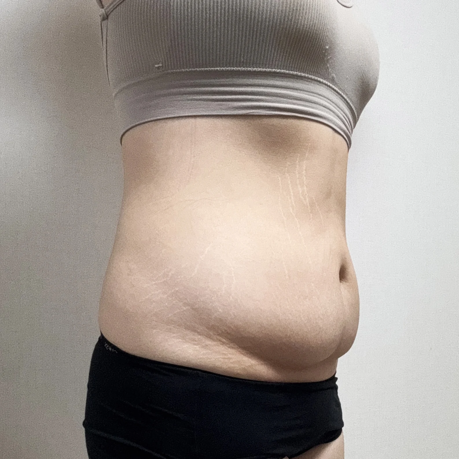 Sharing my abdominoplasty review - Body Contouring Before 2 - TheLINE Plastic Surgery