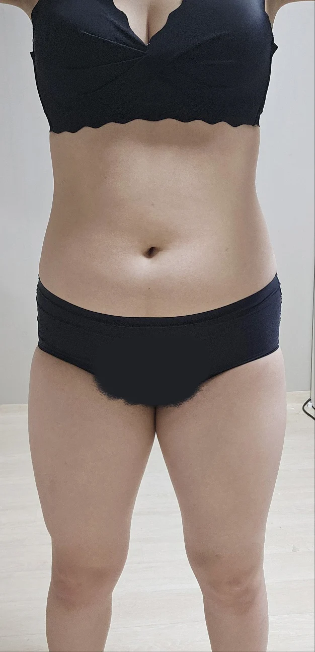 This is my liposuction and fat grafting  - Hip Fat Grafting Before 2 - TheLINE Plastic Surgery