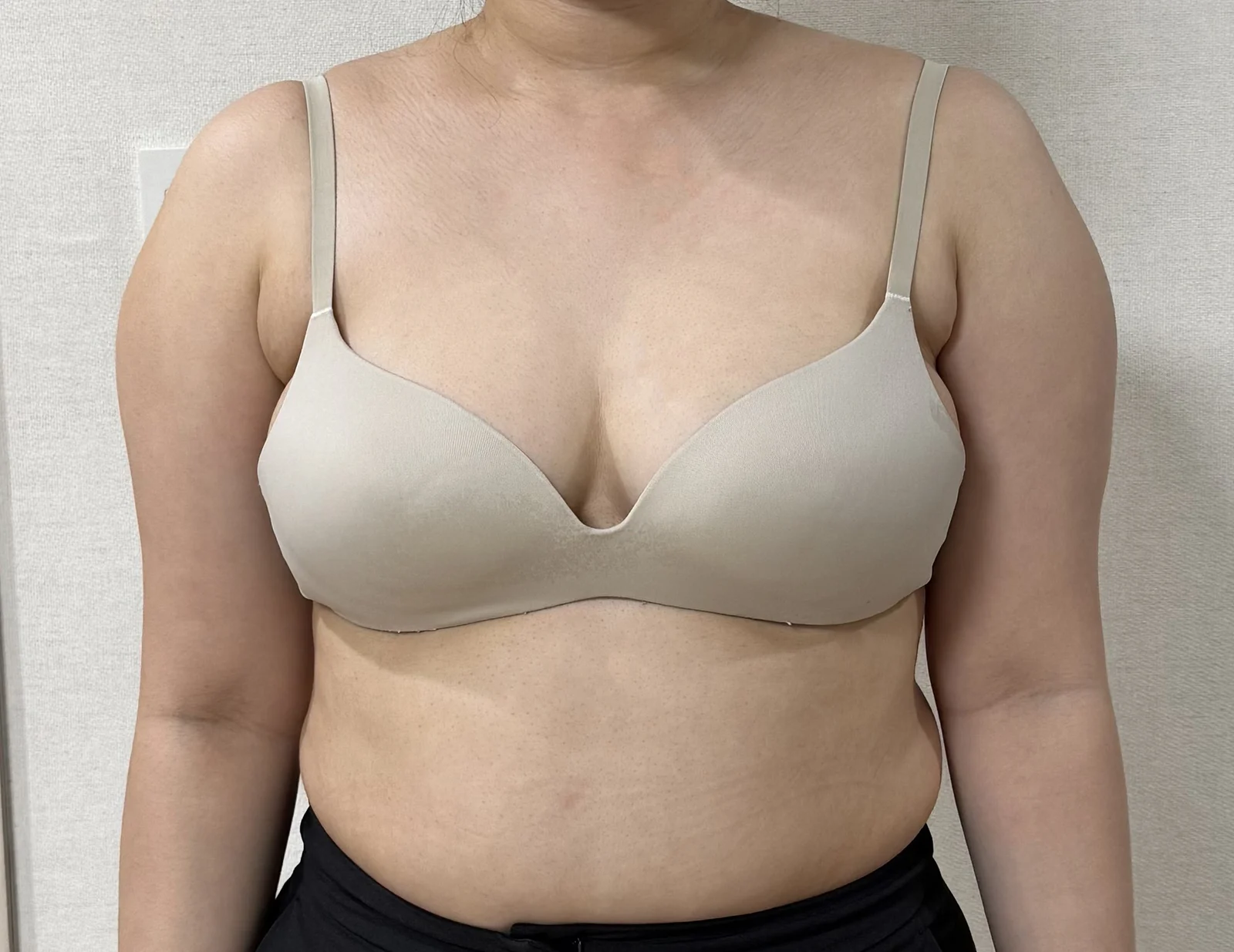 I highly recommend TheLINE~ - Arm Liposuction Before 2 - TheLINE Plastic Surgery