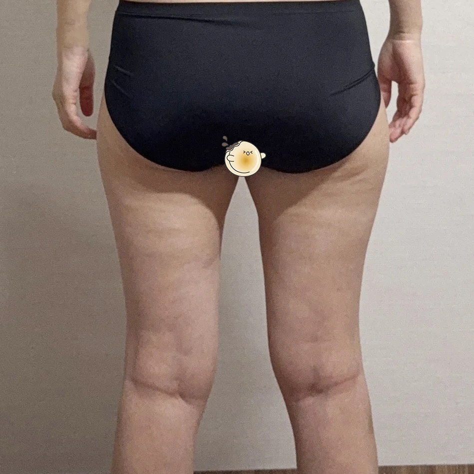 I'm at three months after thigh liposuct - Thigh Liposuction (Lower Body) Before 2 - TheLINE Plastic Surgery