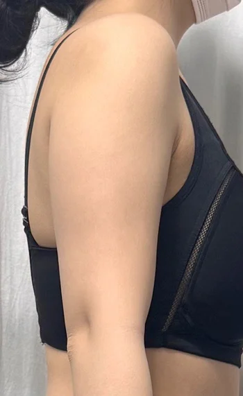 Six months after arm liposuction - Arm Liposuction Before 2 - TheLINE Plastic Surgery