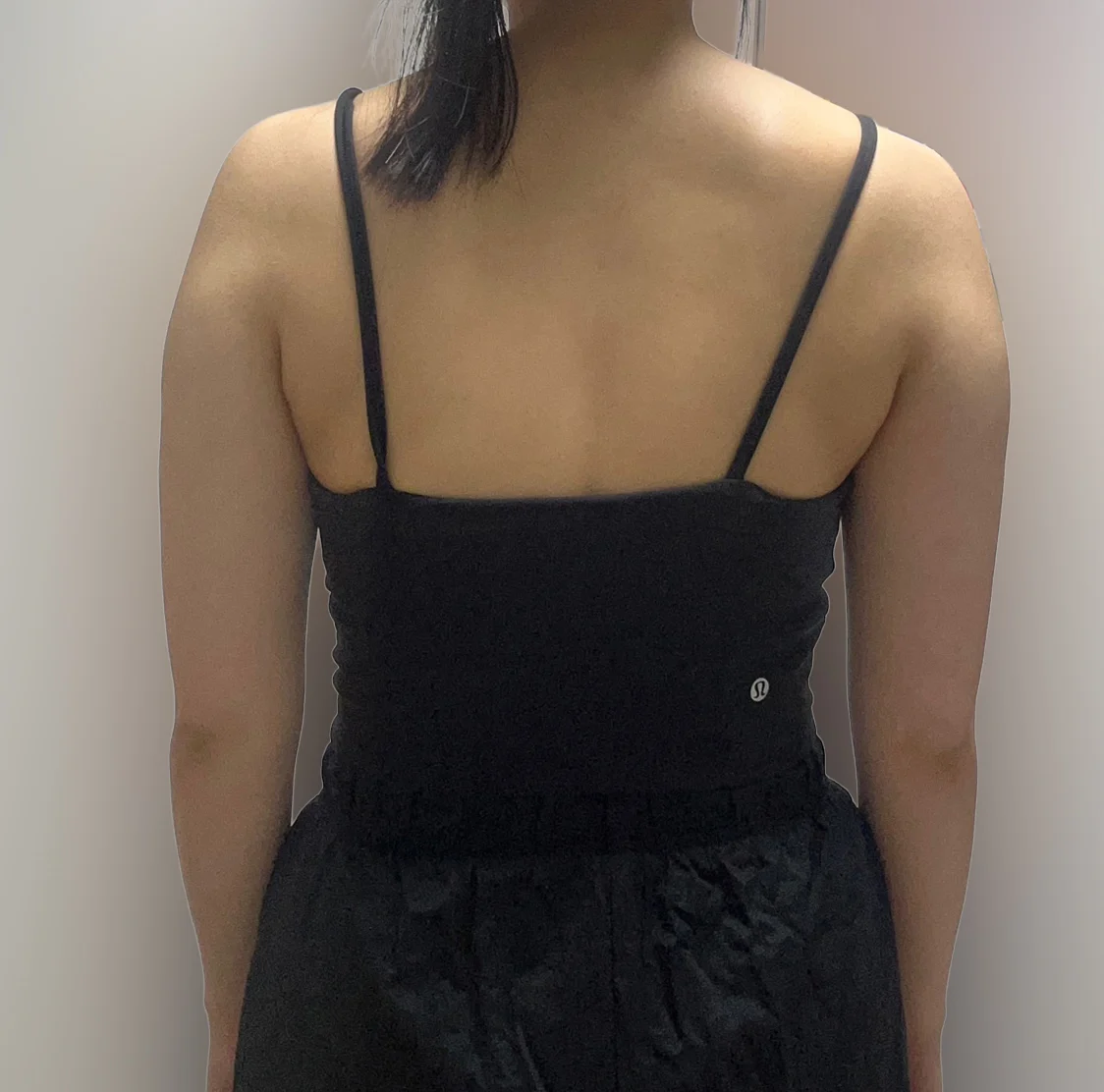 Six-month arm liposuction review - Arm Liposuction Before 2 - TheLINE Plastic Surgery