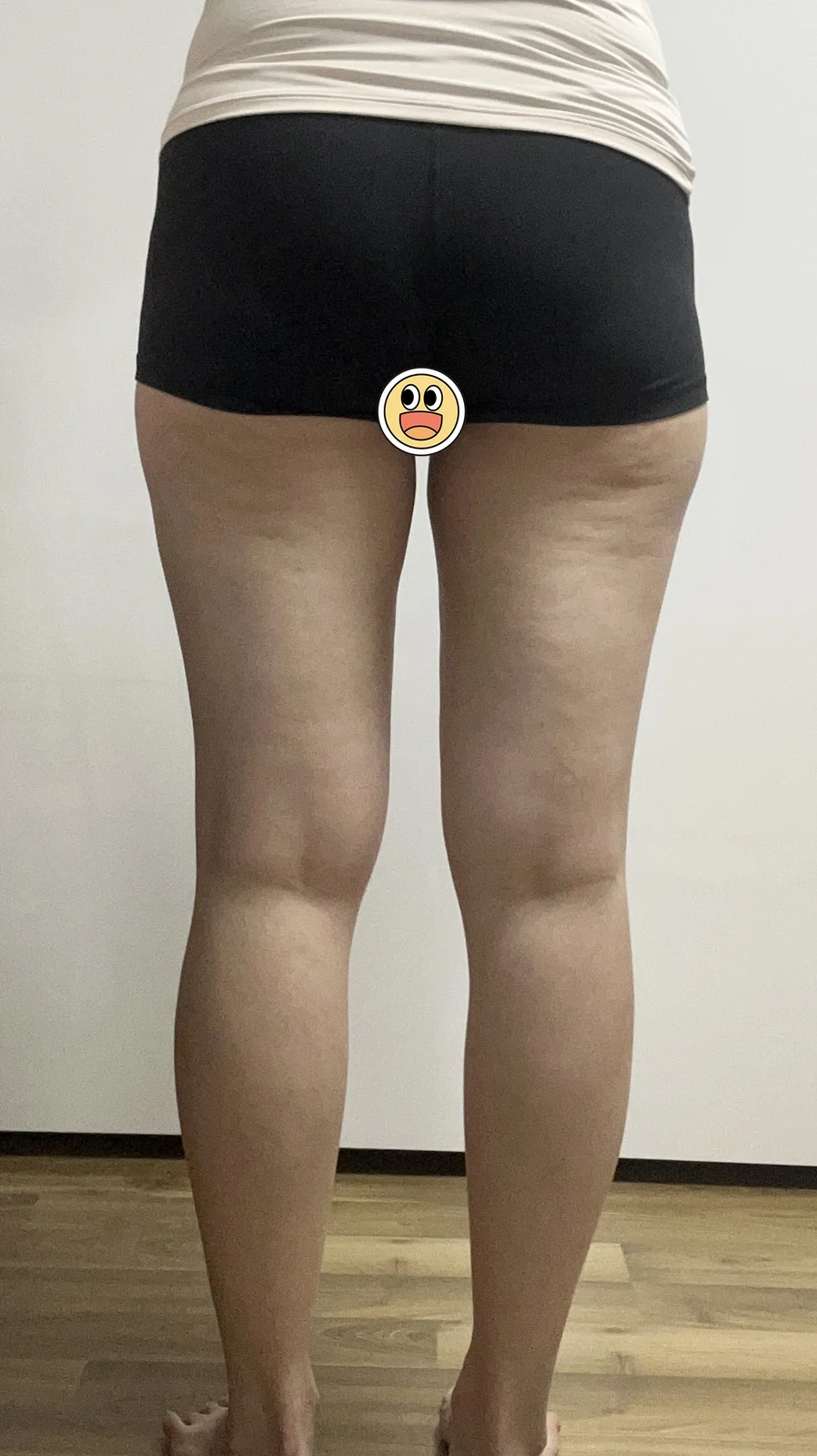 Three-month thigh liposuction review - Thigh Liposuction (Lower Body) Before 2 - TheLINE Plastic Surgery