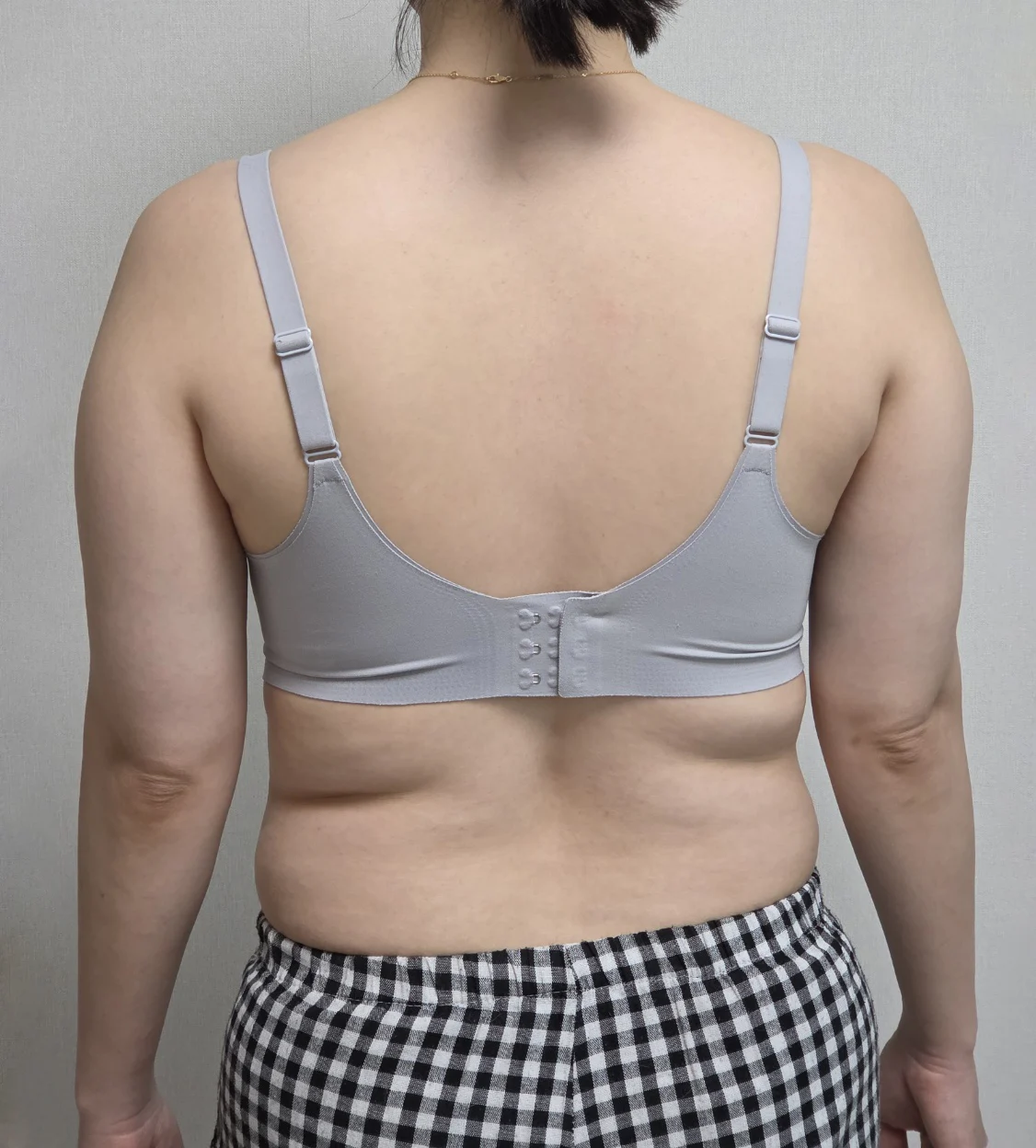 Six months since 270-degree arm + access - Arm Liposuction Before 2 - TheLINE Plastic Surgery