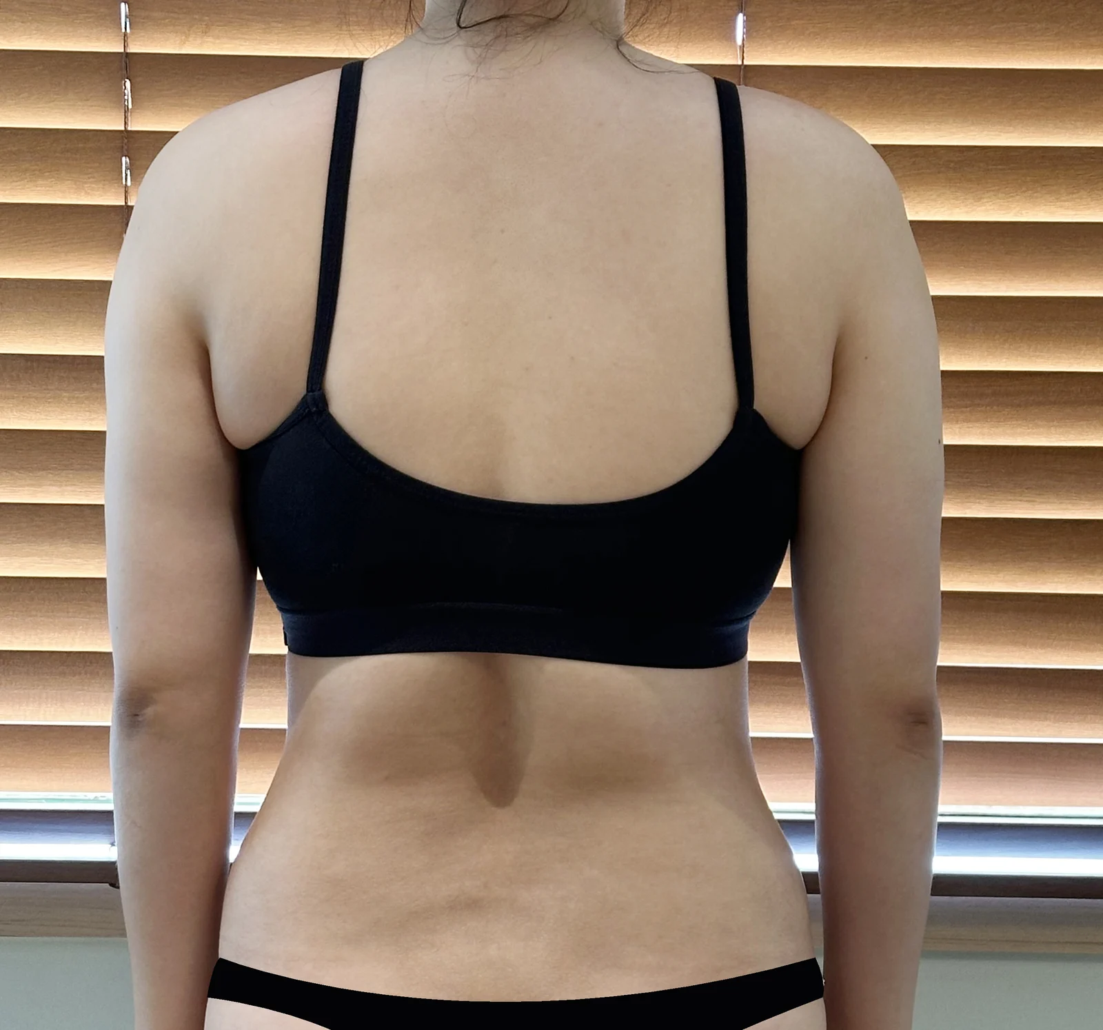 I had 360-degree arm liposuction - Arm Liposuction Before 2 - TheLINE Plastic Surgery