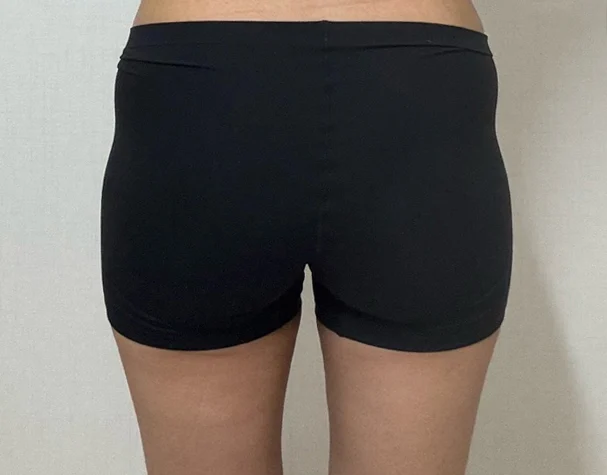 Hip dip grafting review♥ - Hip Fat Grafting surgery Before photo - TheLINE Plastic Surgery
