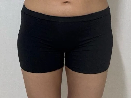 Hip dip grafting review♥ - Hip Fat Grafting Before 2 - TheLINE Plastic Surgery