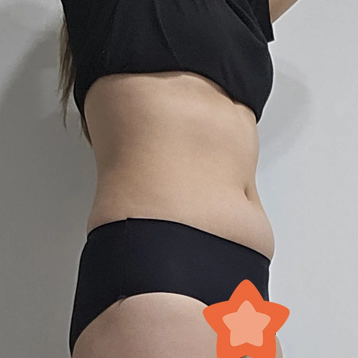 I'm at three months! - Hip Fat Grafting surgery Before photo - TheLINE Plastic Surgery