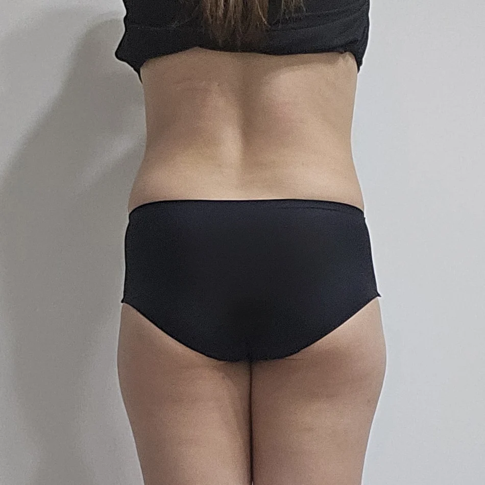 I'm at three months! - Hip Fat Grafting Before 2 - TheLINE Plastic Surgery