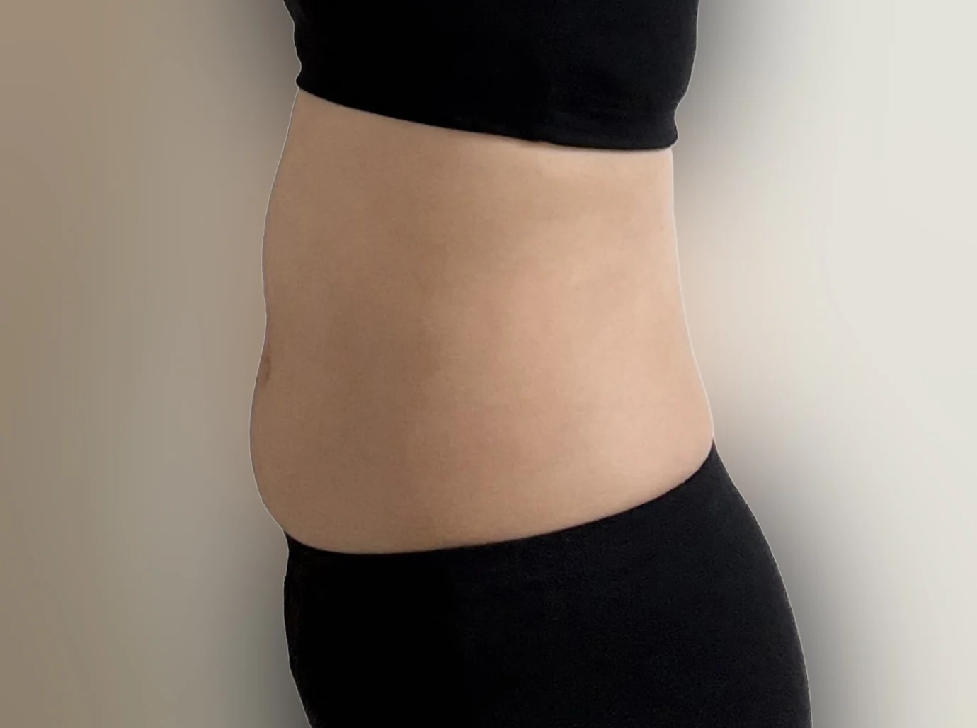 ★One-month abdominal lipo review★ - Abdominal Liposuction (Upper Body) Before 2 - TheLINE Plastic Surgery