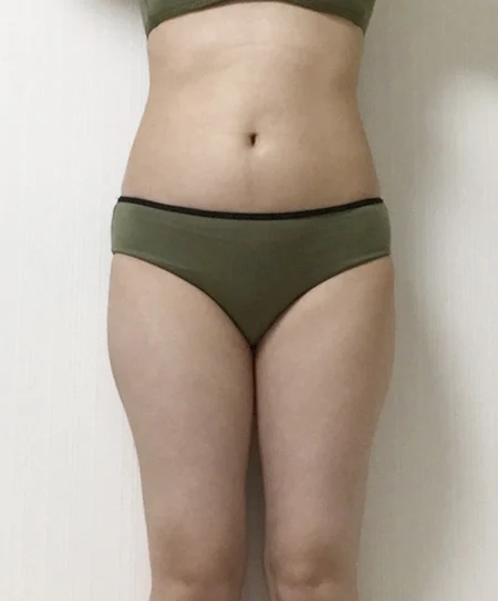 Even when I gain weight the contour stay - Body Contouring Before 2 - TheLINE Plastic Surgery