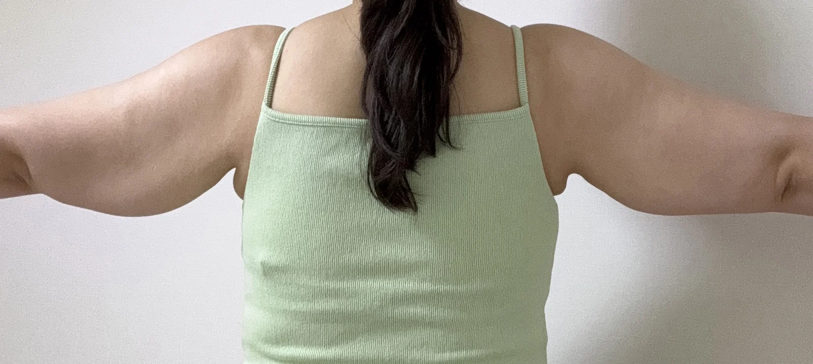 One month after arm lipo and lift surger - Arm Liposuction Before 2 - TheLINE Plastic Surgery