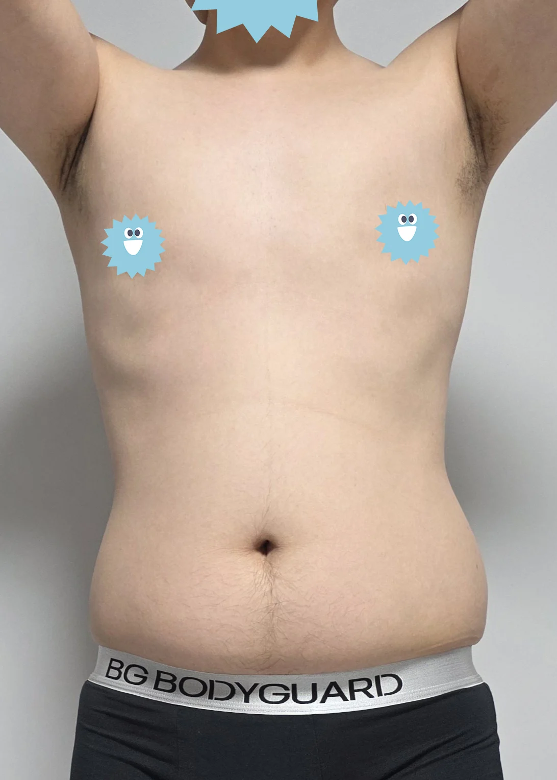 One month after liposuction - Abdominal Liposuction (Upper Body) surgery Before photo - TheLINE Plastic Surgery