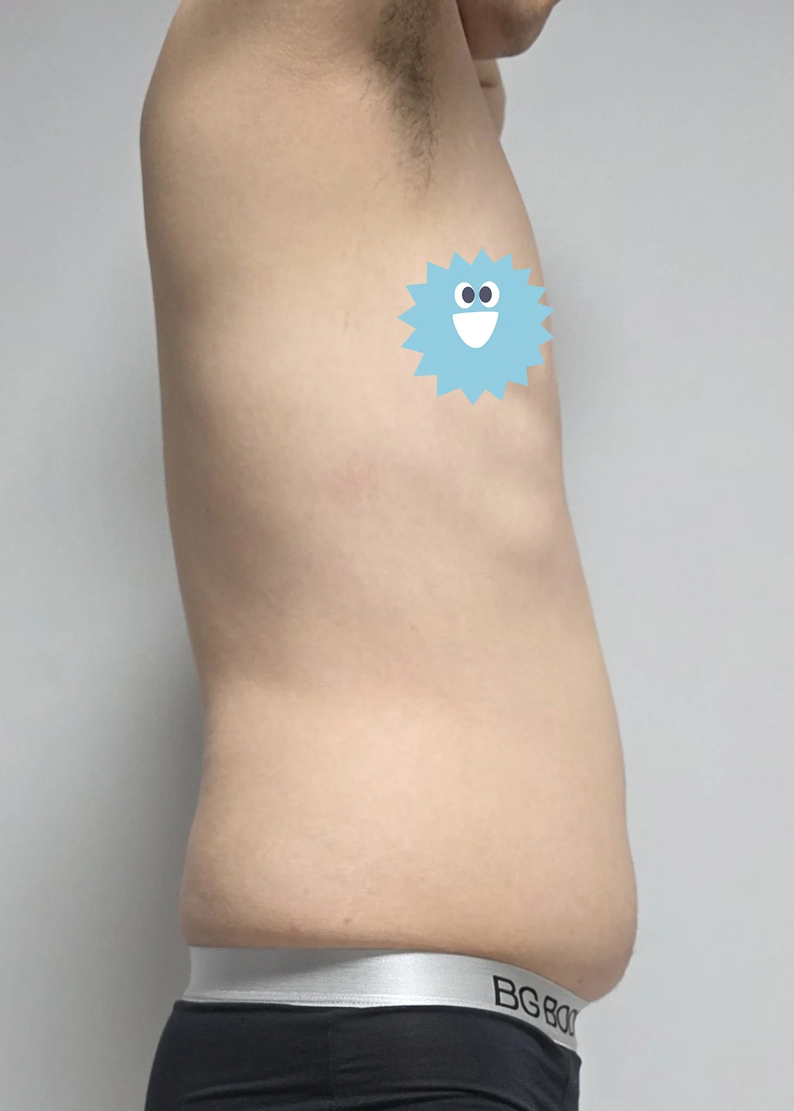 One month after liposuction - Abdominal Liposuction (Upper Body) Before 2 - TheLINE Plastic Surgery