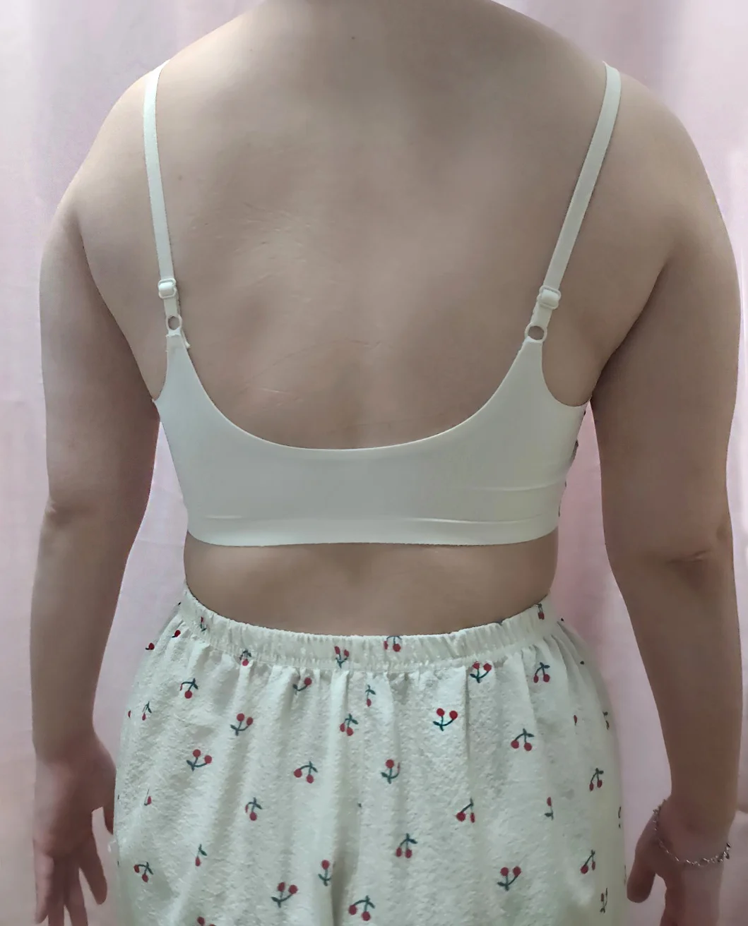 About 3 months since my arm and accessor - Arm Liposuction Before 2 - TheLINE Plastic Surgery