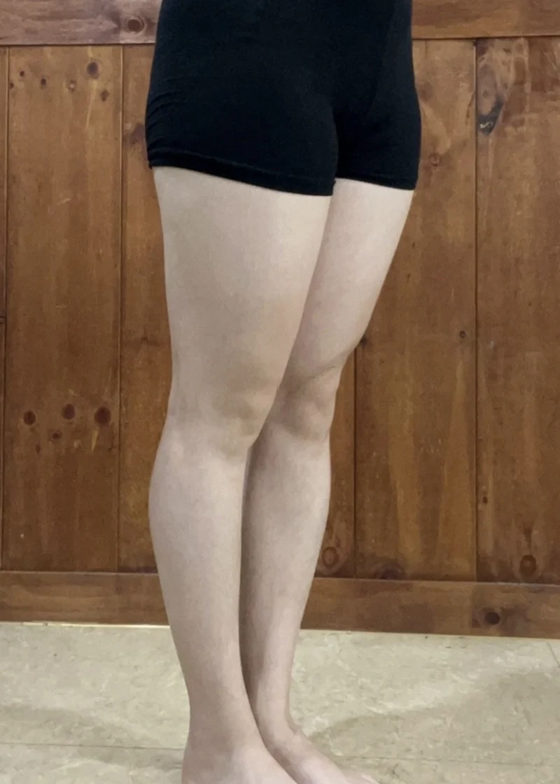 My review at 1 year and 3 months! - Thigh Liposuction (Lower Body) Before 2 - TheLINE Plastic Surgery