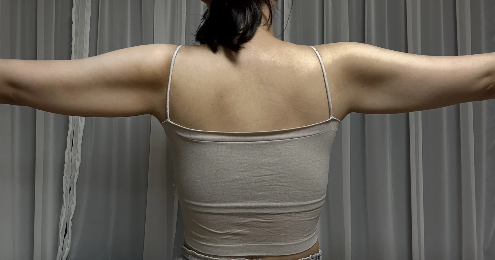 I had an arm lift + arm lipo~! - Body Contouring Before 2 - TheLINE Plastic Surgery