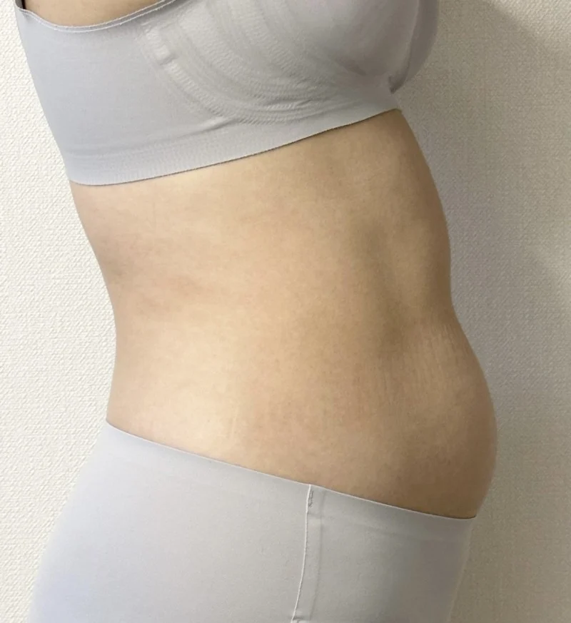 I'd like to recommend it - Arm Liposuction Before 2 - TheLINE Plastic Surgery