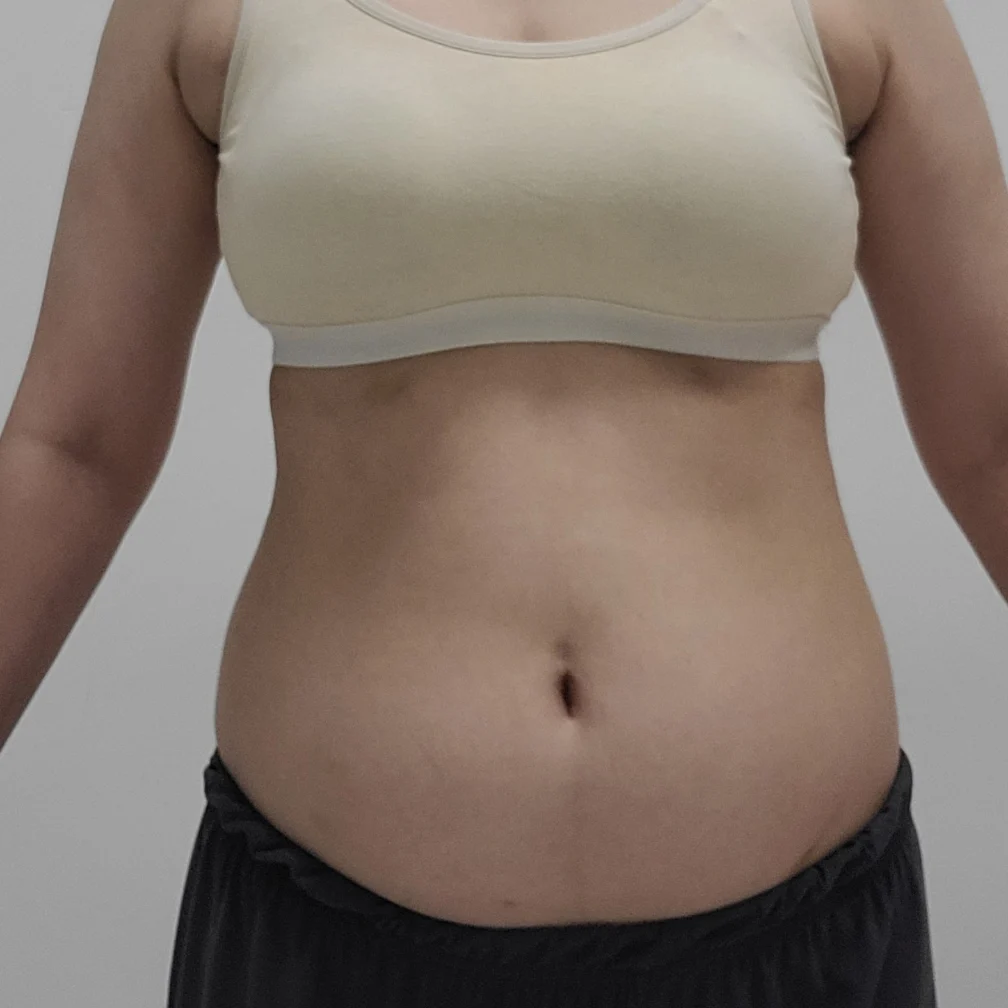Abdomen and flank lipo review - Abdominal Liposuction (Upper Body) Before 2 - TheLINE Plastic Surgery