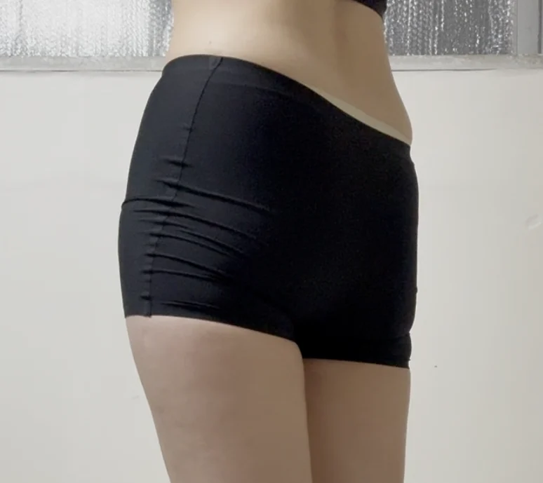 3 months after my hip and thigh surgery - Hip Fat Grafting Before 2 - TheLINE Plastic Surgery