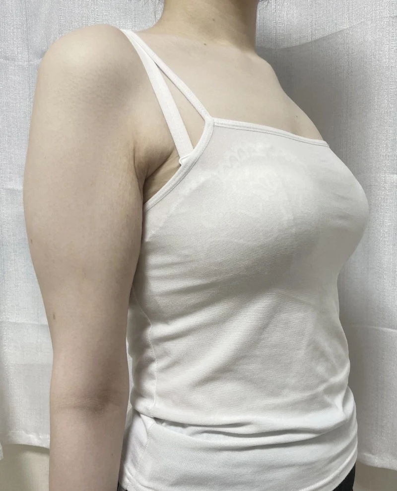 5 months after stem cell arm lipo + arm  - Body Contouring Before 2 - TheLINE Plastic Surgery