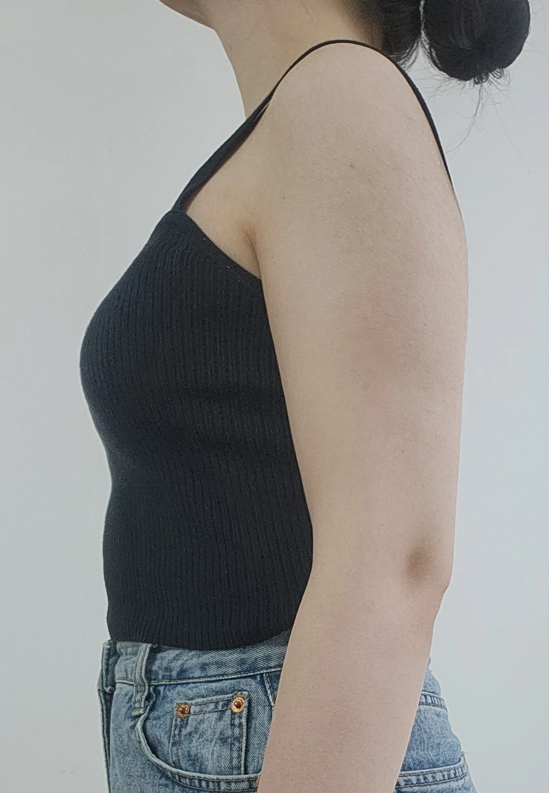 6 months after arm lipo - Arm Liposuction Before 2 - TheLINE Plastic Surgery