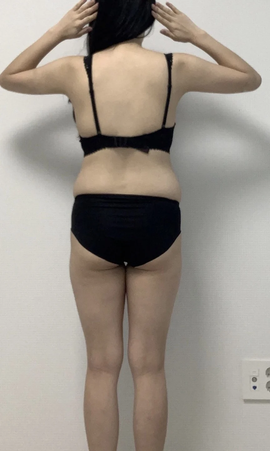 Definitely get hip fat grafting done tog - Hip Fat Grafting Before 2 - TheLINE Plastic Surgery