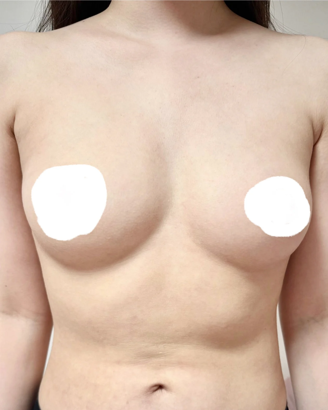 Breast fat grafting review - Breast Fat Grafting Before 2 - TheLINE Plastic Surgery