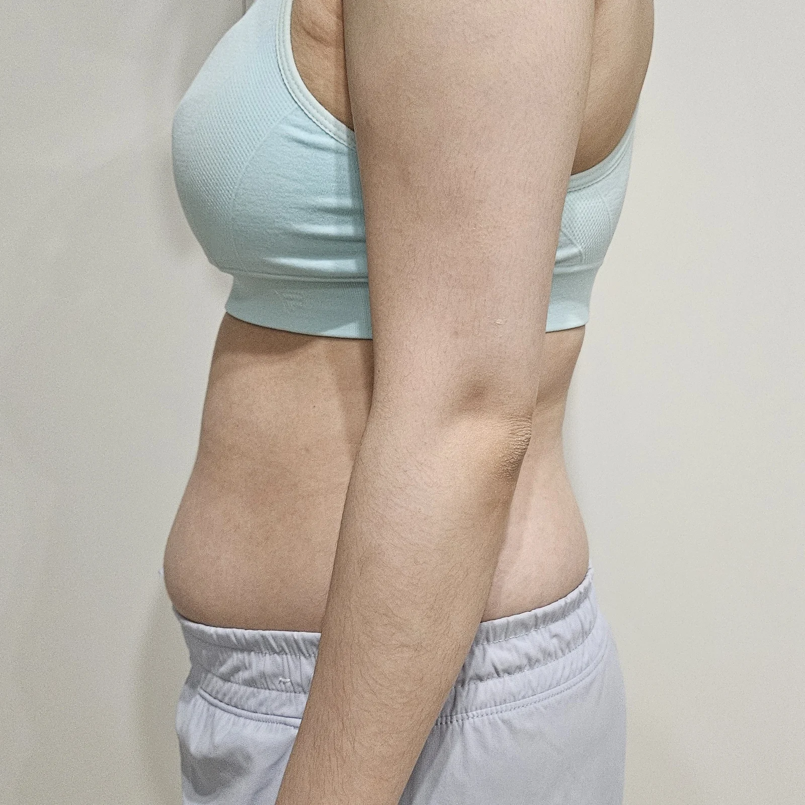 Abdomen, love handles, arms and upper ar - Arm Liposuction Before 2 - TheLINE Plastic Surgery