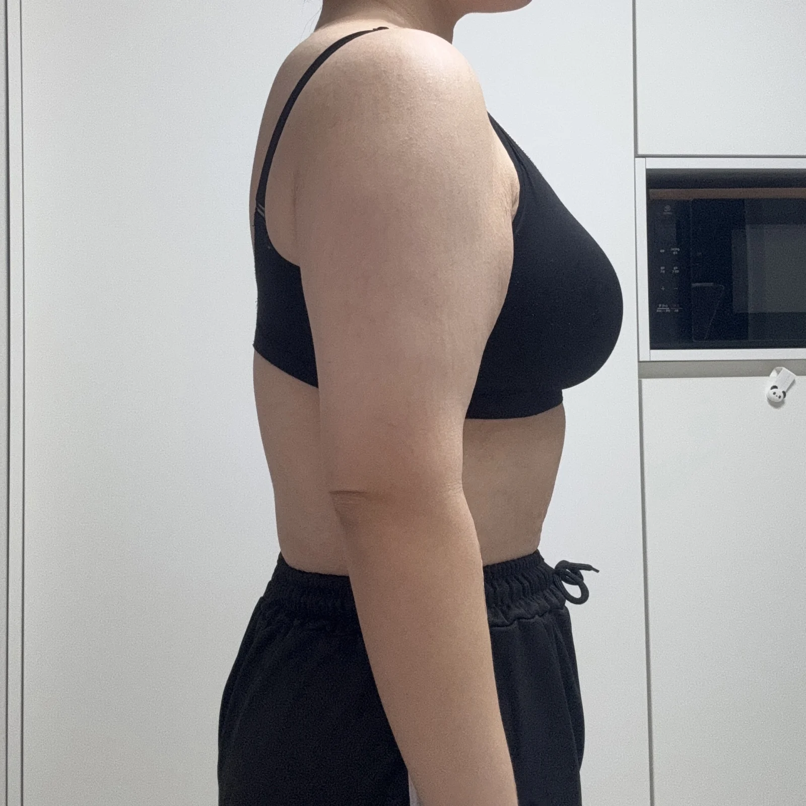 Writing my arm lipo + arm lift review ri - Body Contouring surgery Before photo - TheLINE Plastic Surgery