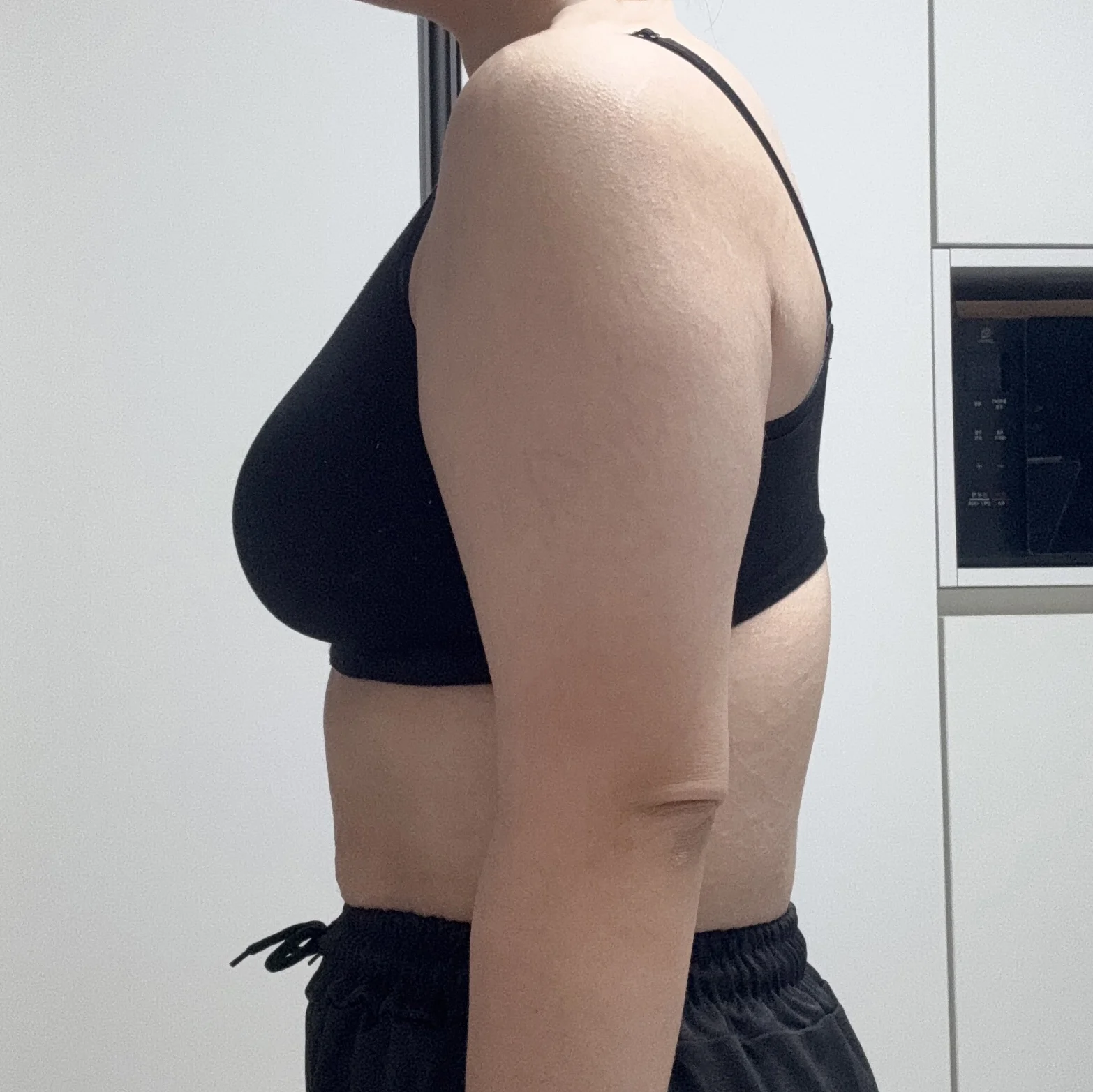 Writing my arm lipo + arm lift review ri - Body Contouring Before 2 - TheLINE Plastic Surgery