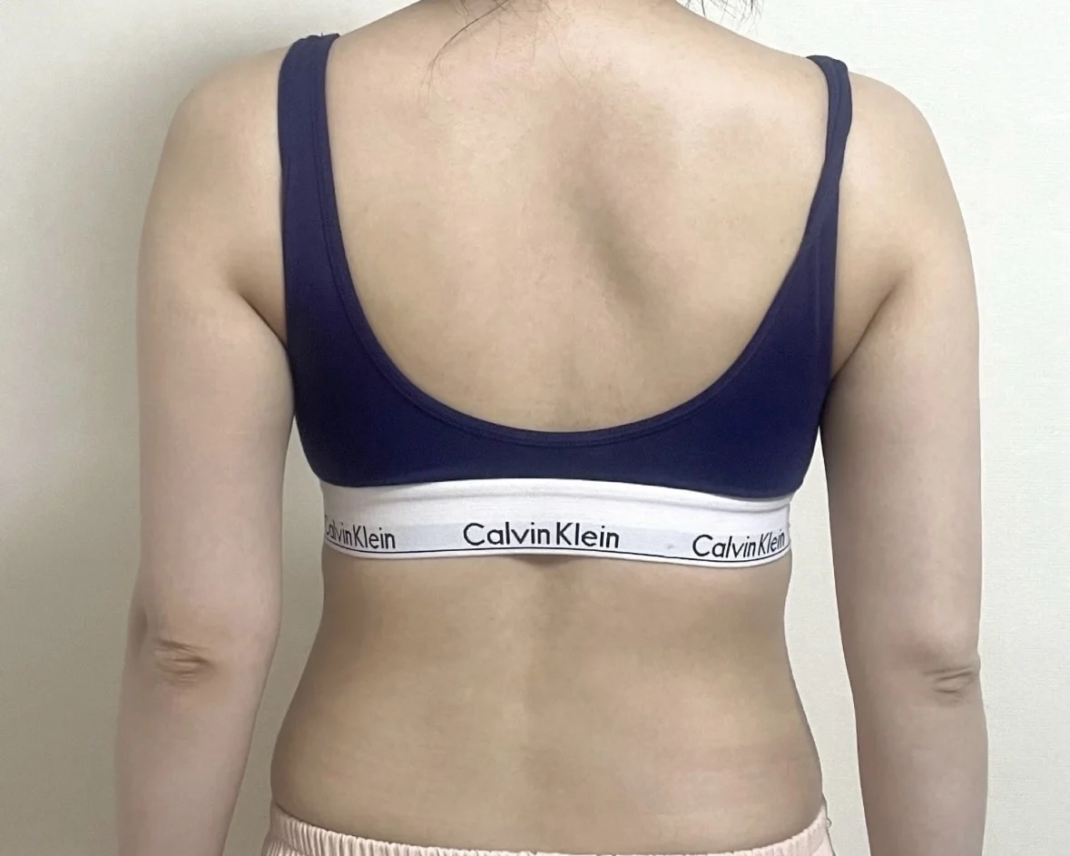 Thank you Dr. Baek for giving me back my - Arm Liposuction Before 2 - TheLINE Plastic Surgery