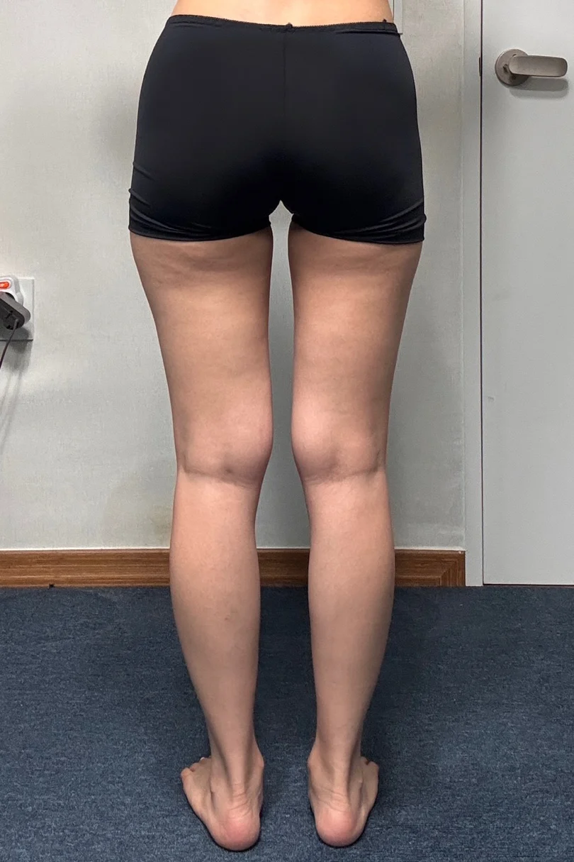 Six months on and still so happy with my - Thigh Liposuction (Lower Body) surgery Before photo - TheLINE Plastic Surgery