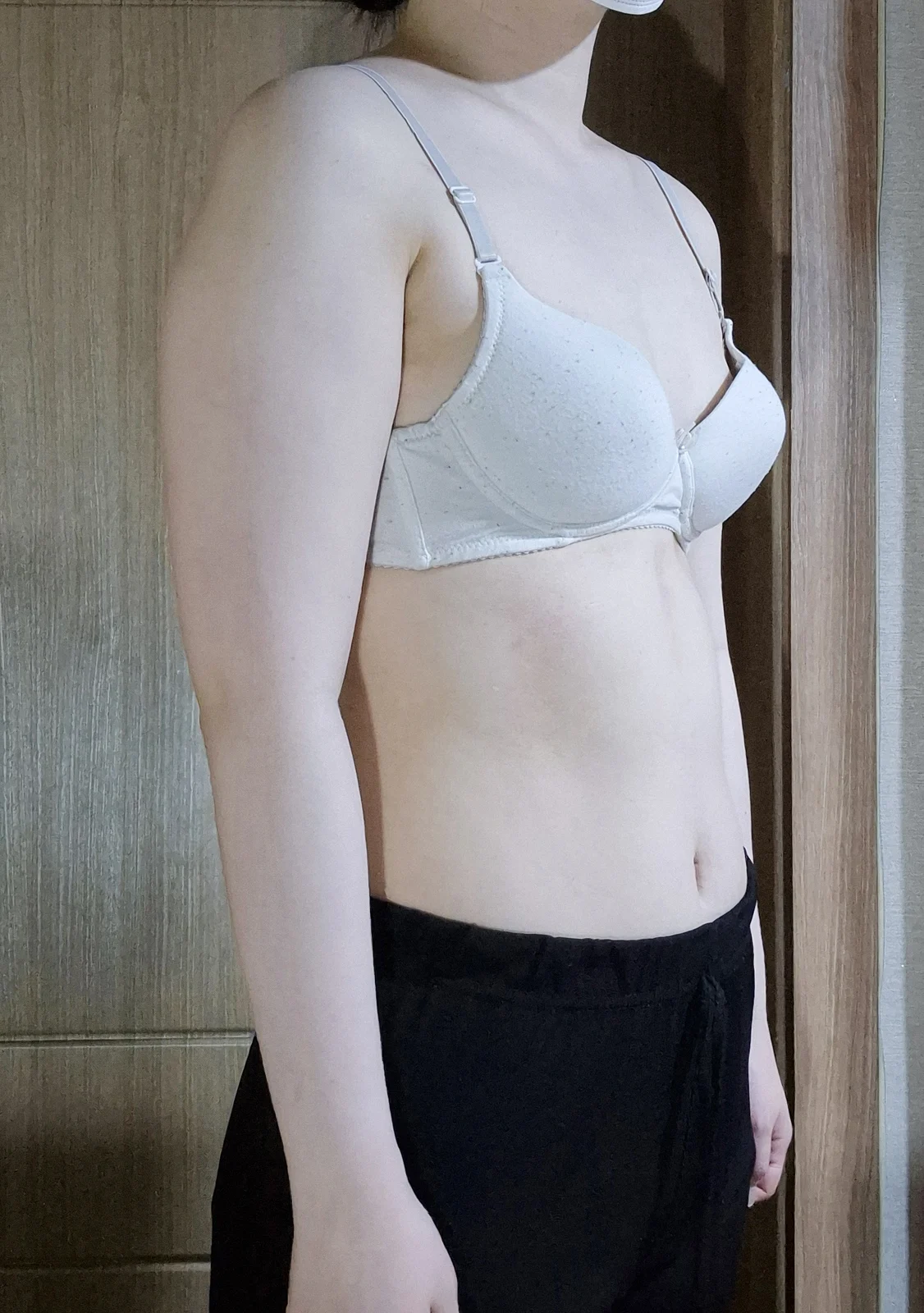 My 6-month review after upper arm and ac - Arm Liposuction Before 2 - TheLINE Plastic Surgery