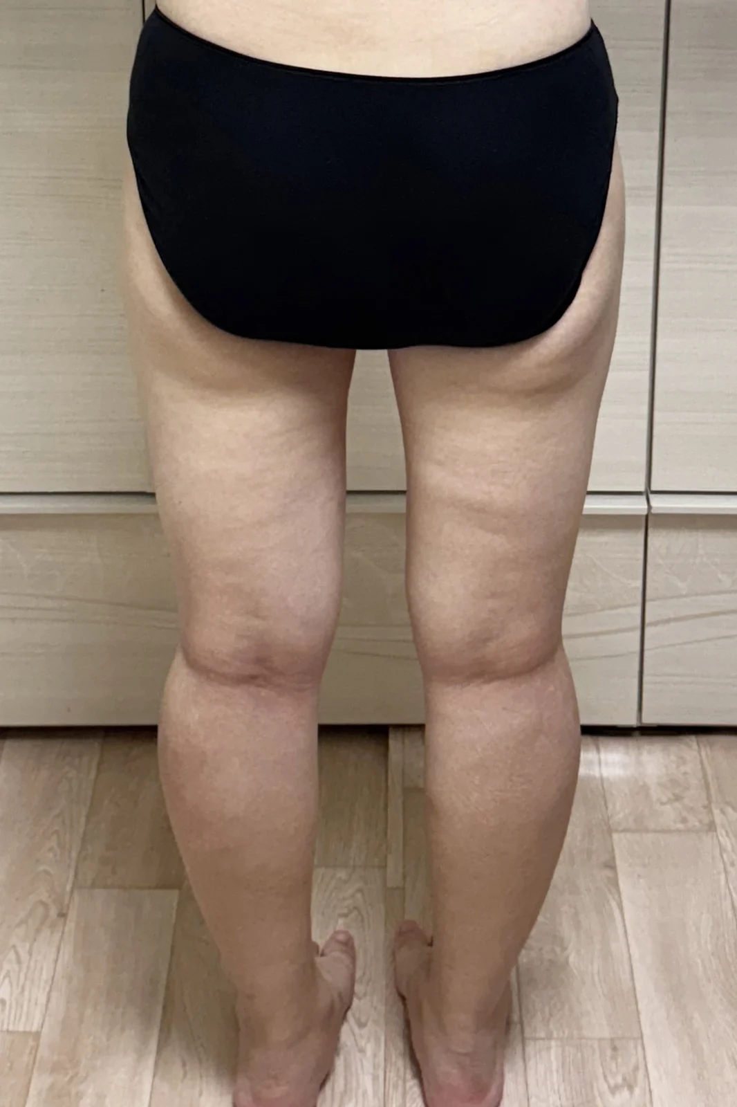 My thigh liposuction revision review! - Thigh Liposuction (Lower Body) Before 2 - TheLINE Plastic Surgery