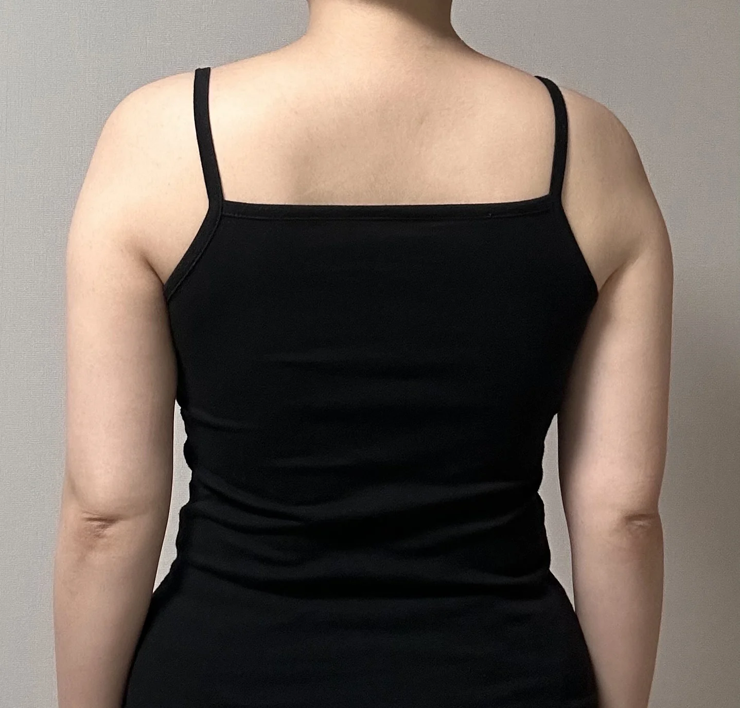 My 3-month upper arm fat grafting review - Arm Liposuction Before 2 - TheLINE Plastic Surgery