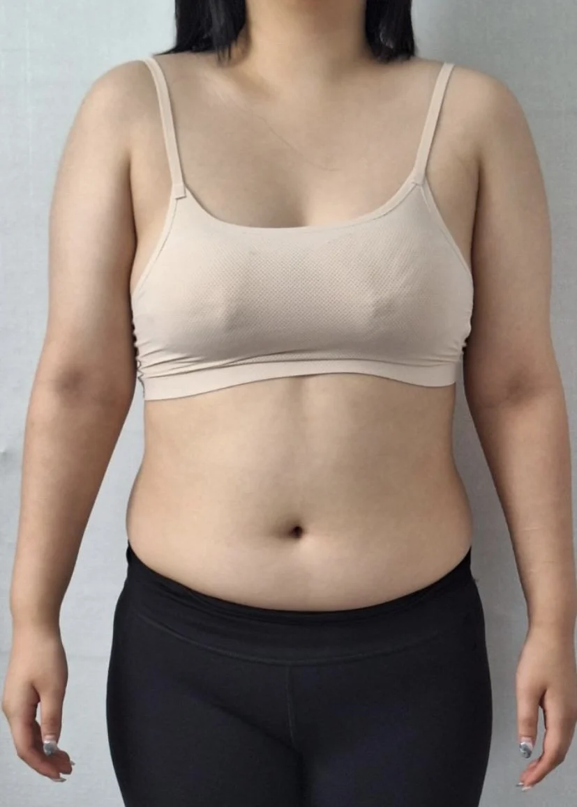 I'm living such a satisfying life - Other Liposuction surgery Before photo - TheLINE Plastic Surgery