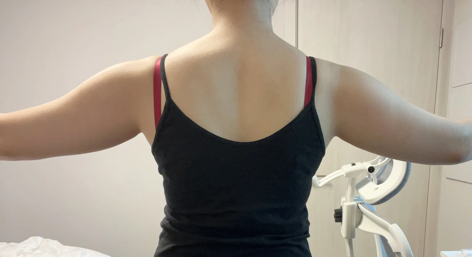 3 months after arm lipo! - Arm Liposuction Before 2 - TheLINE Plastic Surgery