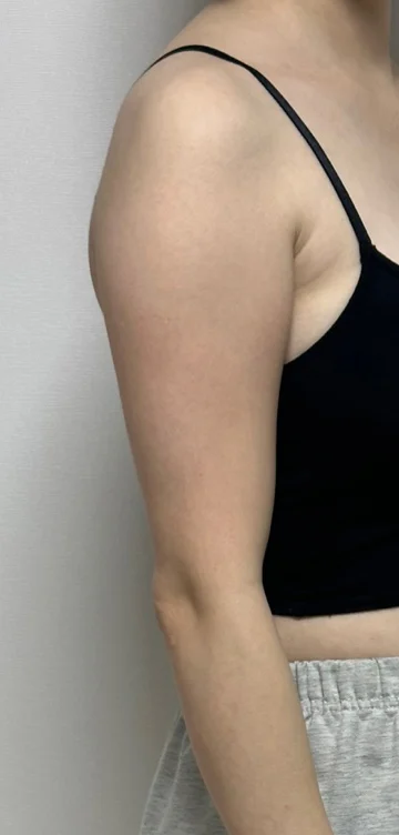 Before and after review of arm and upper - Arm Liposuction Before 2 - TheLINE Plastic Surgery